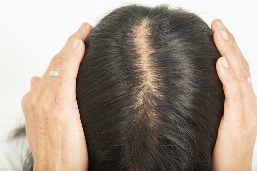 女人老是掉头发是什么原因 要怎么治疗？