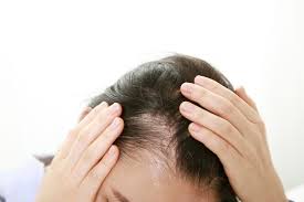 很多人都会出现掉头发的现象，那么老掉头发的原因是什么呢？