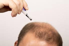 脂溢性脱发用什么洗头？脂溢性脱发是什么原理？