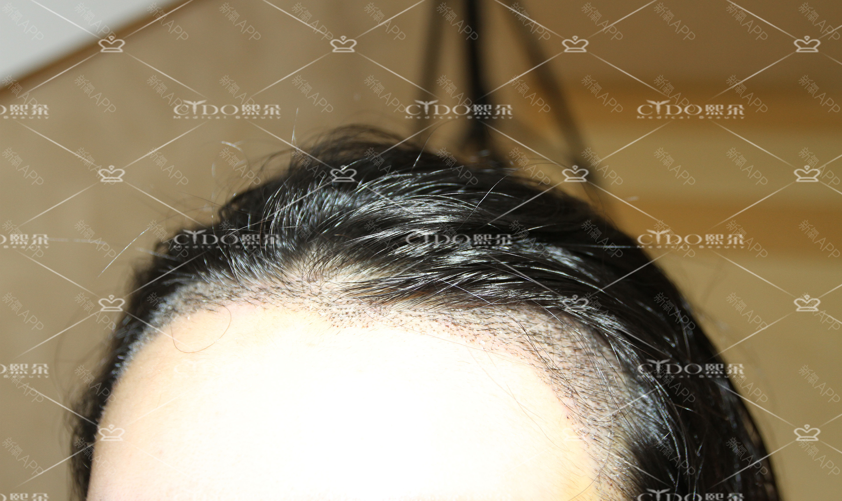 头顶头发加密经历分享，头发稀疏的看过来