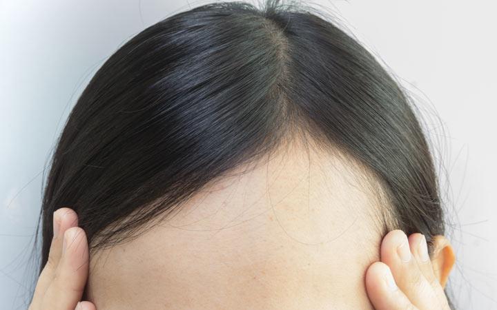 女人为什么掉头发，有什么好的解决方法呢？