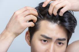 毛发移植成活率怎么样呢？头皮屑会引起脱发吗？
