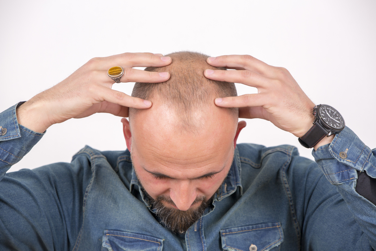 脂溢性脱发能根治吗，大家了解脂溢性脱发问题吗？