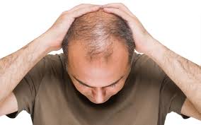 压力会导致男性脱发吗？