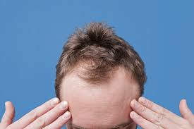 男性脱发是遗传疾病吗？