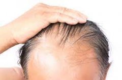 男性脱发是什么原因引起的？