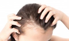 哪些坏习惯会导致女性脱发，要怎么预防？