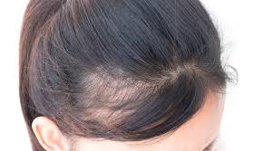 多囊卵巢综合征脱发的常见症状