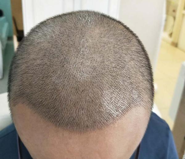 脂溢性脱发是脂溢性皮炎引起的吗