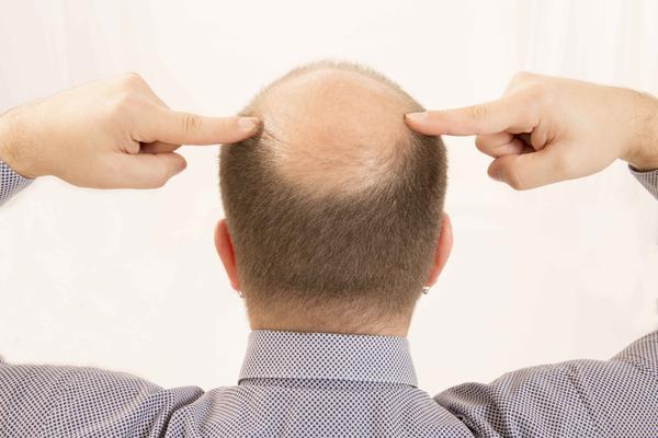 脂溢性脱发是脂溢性皮炎引起的吗，要怎么治疗