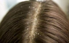 头皮屑是导致脱发的原因吗?要怎么治疗?