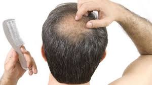 哪些原因会导致脱发，这6种错误习惯会加剧脱发！