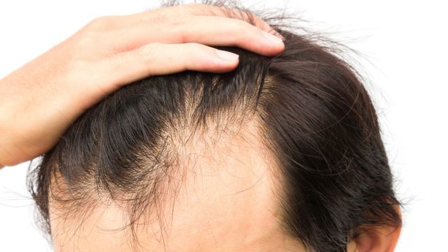 发质受损经常脱落怎么办？无痕植发可以了解下