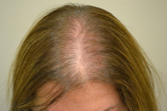 脂溢性脱发怎么治疗效果最佳?不同患者一定要对症治疗!