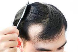 男性雄激素性脱发的原因是什么？要怎么治疗？