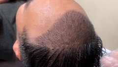 怎么判断肾虚型脱发吗？肾虚型脱发有哪些表现？