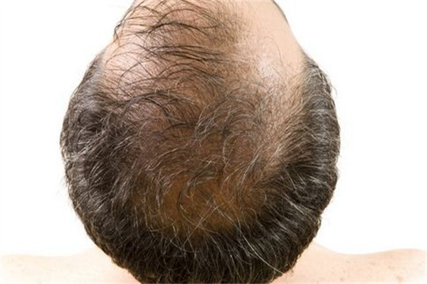 男性毛发种植一般多少钱