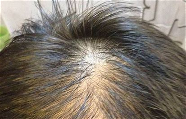 慢性脂溢性脱发是怎么回事？有什么好的解决方法呢？