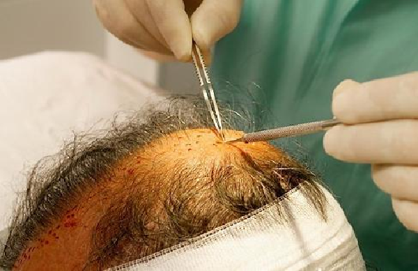 脱发原因千千万，如何治疗脂溢性脱发呢？