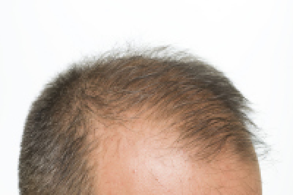 男性型脱发是怎么回事？该如何治愈？