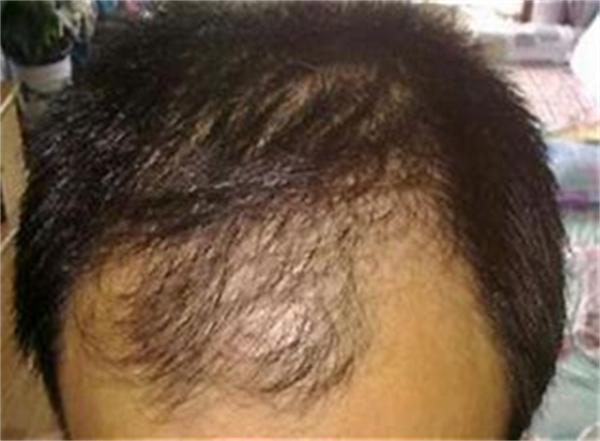 怎么治疗脂溢性脱发？哪种方法有效？
