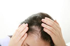 脂溢性脱发是怎么回事？脂溢性脱发能治好吗？