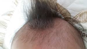脂溢性脱发怎么办，能治好吗？