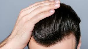 治疗脂溢性脱发的方法有哪些 哪种方法有效