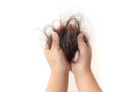 掉头发怎么医治 哪些治疗方法有效
