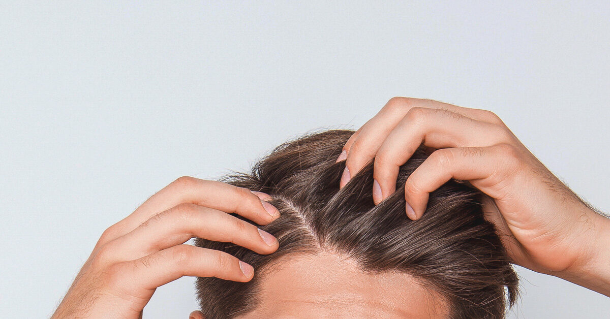 慢性脂溢性脱发怎么治疗 哪种方法更有效