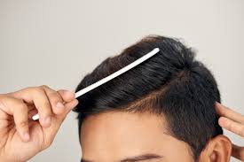 毛发种植技术好吗 对治疗脱发有效吗