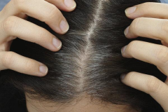 脂溢性脱发如何治疗，毛发种植手术怎么样？