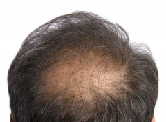 肾虚型脱发怎么治，有什么好的治疗方法吗？