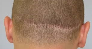 头上有疤痕没头发怎么办？疤痕头发种植或可解忧