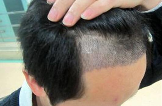 什么是毛发种植手术
