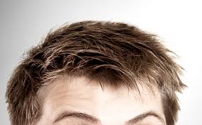 什么是毛发种植手术