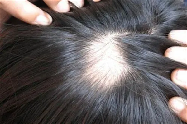sfue巨量毛发种植技术