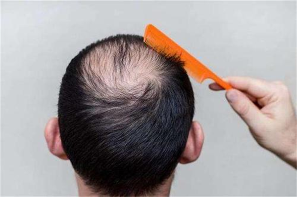 种植头发技术