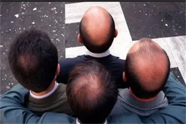 植发效果能保持多久，什么是毛发种植手术呢？