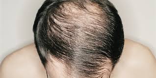 毛发种植大概要多少钱，有什么好的植发技术吗？