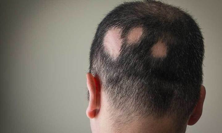 男士毛发种植，男士有哪些专属的植发技术呢？