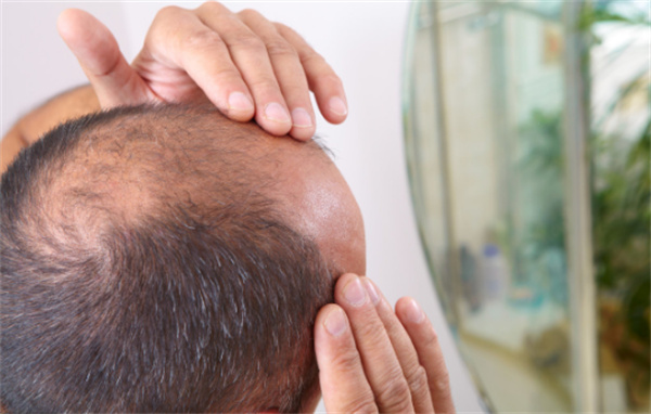 怎样治疗脂溢性脱发，有什么好的解决方法吗？