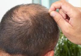 毛发移植大概多少钱，大家对于毛发种植手术了解吗？