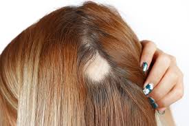 鬓角头发少怎么办，鬓角植发手术可以解决吗？