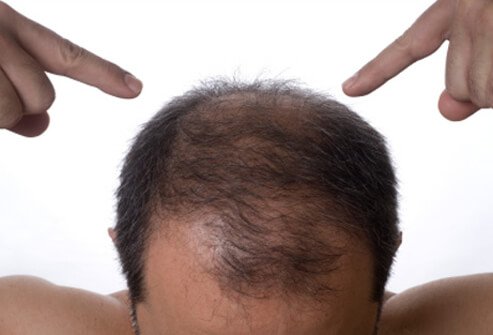 人到中年脱发怎么办，有哪些具体的脱发原因呢？