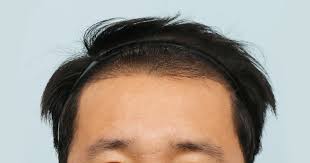 毛发种植可行吗，毛发种植手术的安全性高吗？