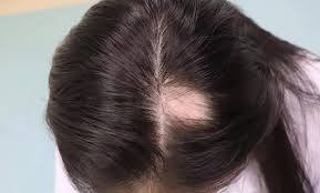 治疗脂溢性脱发方法