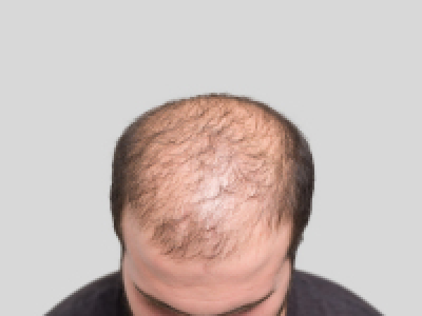 植发会有疤痕吗，毛发种植手术的