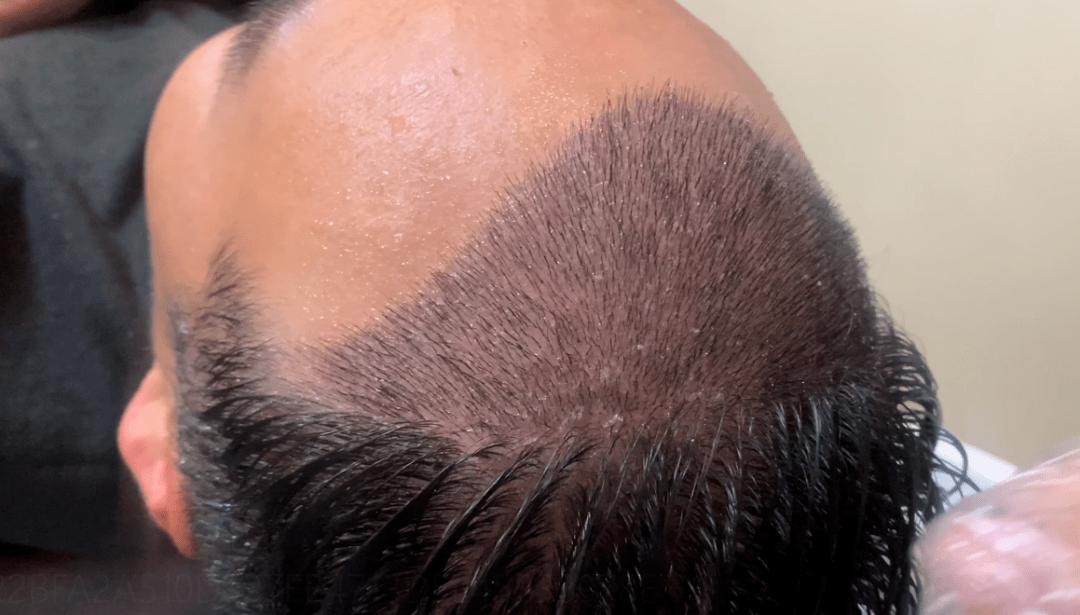男人秃头的原因有哪些 男人为什么容易脱发