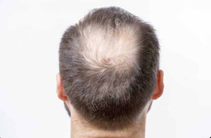 洗头掉头发掉多少算正常 脱发常见的原因是什么